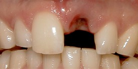 Before Before