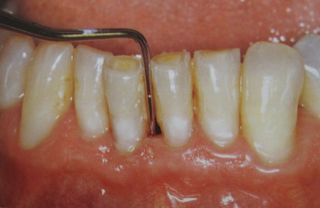 Periodontal-disease
