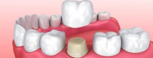 Porcelain Crowns (Caps)