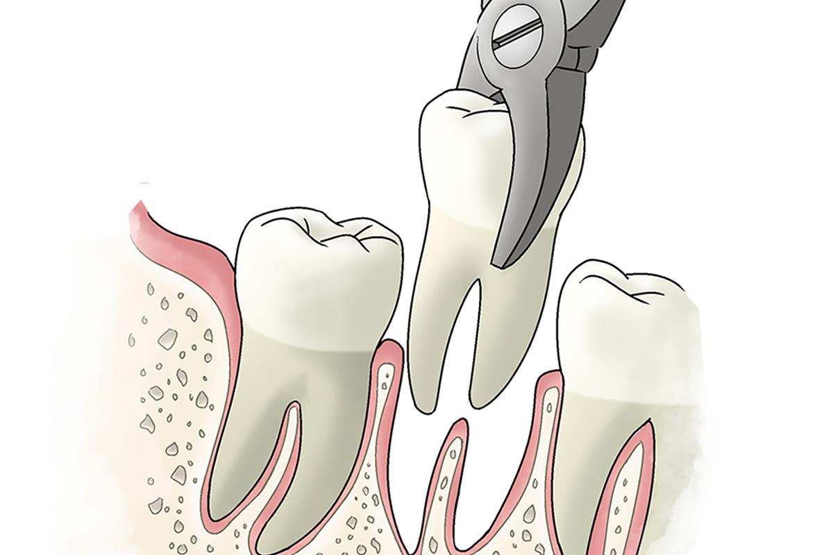 TOOTH EXTRACTIONS TOOTH EXTRACTIONS