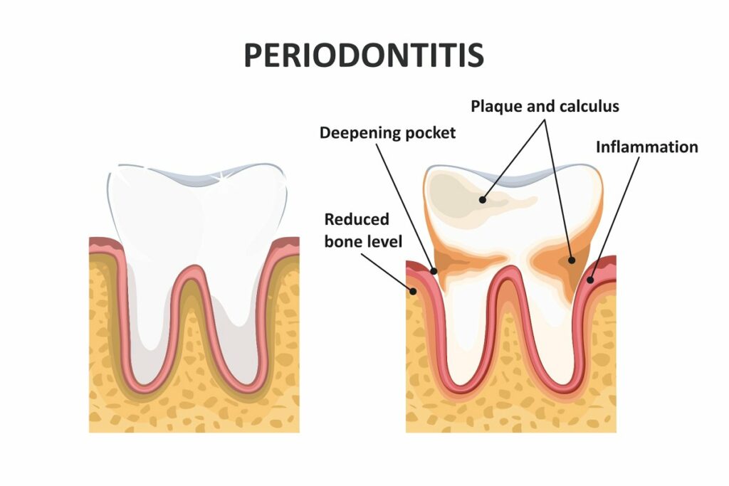 periodontal evaluation