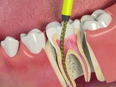 root-canal-therapy root-canal-therapy